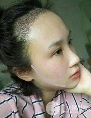 武漢天申胡麗醫(yī)生發(fā)際線種植真實案例，并附上前后對比圖片