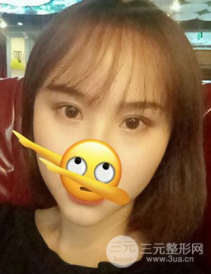 武漢天申胡麗醫(yī)生發(fā)際線種植真實案例，并附上前后對比圖片