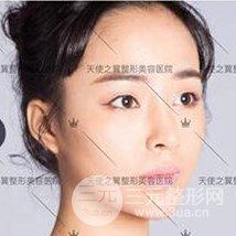 面部自體脂肪填充+隆鼻整形+雙眼皮案例，恢復(fù)果照片~