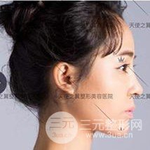 面部自體脂肪填充+隆鼻整形+雙眼皮案例，恢復(fù)果照片~