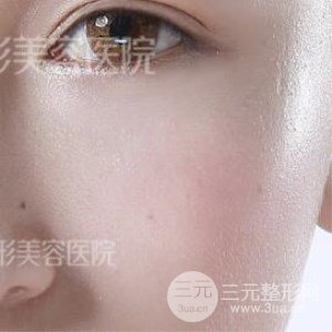 芭比雙眼皮+去眼袋案例分享，還有恢復(fù)過程照片哦~