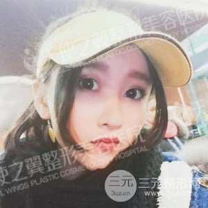 芭比雙眼皮+去眼袋案例分享，還有恢復(fù)過程照片哦~