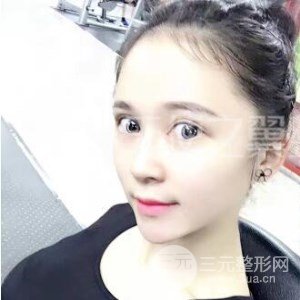 芭比美眼+假體隆胸真是案例果圖片分享~