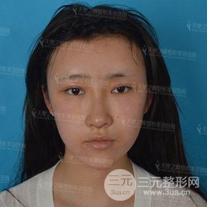 自體脂肪面部填充+全鼻金雕真實(shí)案例，恢復(fù)照片分享~