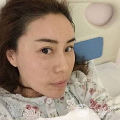 武漢美侖陳遠(yuǎn)海自體脂肪填充全臉案例，附上前后對比圖片