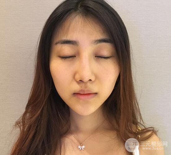 隆鼻整形術(shù)后1-7天的照片，前后對(duì)比果圖分享