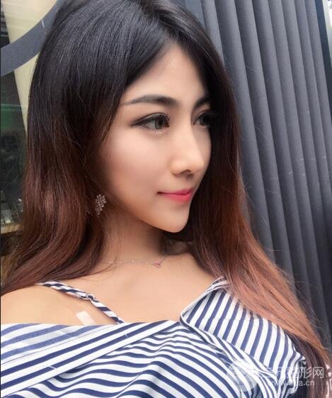 隆鼻整形術(shù)后1-7天的照片，前后對(duì)比果圖分享