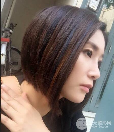 打完鼻子恢復(fù)的過程圖，隆鼻案例日記分享