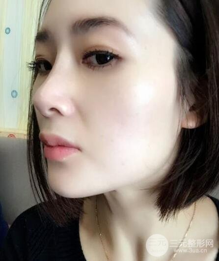 打完鼻子恢復(fù)的過程圖，隆鼻案例日記分享