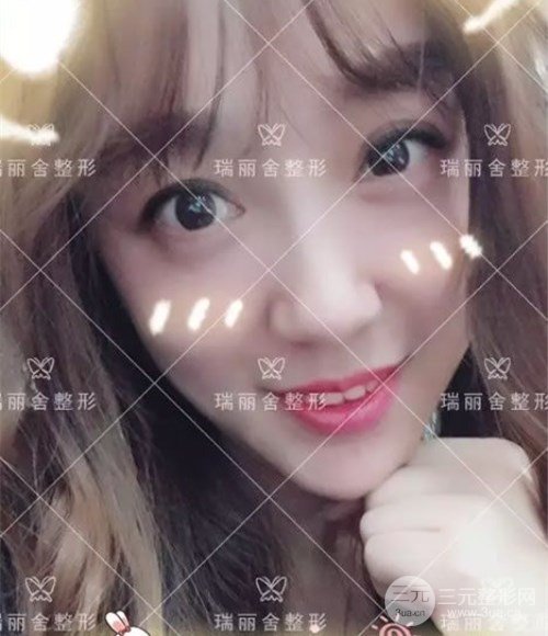 臉頰脂肪填充術(shù)后30天果