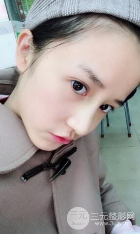 柏麗李勁良假體隆鼻案例果分享！小巧精致又立體~