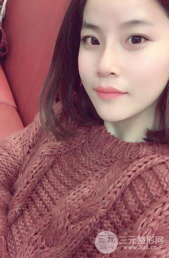 隆鼻鼻翼縮小全過(guò)程和術(shù)后照片分享，隨意揉捏很OK