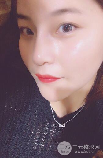 隆鼻鼻翼縮小全過(guò)程和術(shù)后照片分享，隨意揉捏很OK