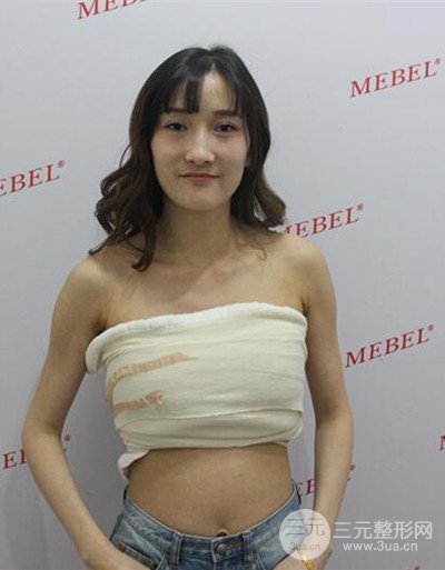 蘇州美貝爾假體隆胸案例，對比圖恢復(fù)過程分享~