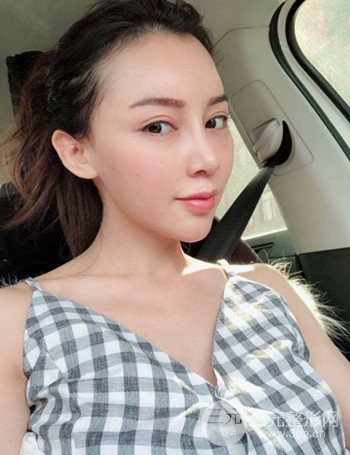 上海隆鼻失敗手術(shù)修復(fù)果超乎想象、前后對(duì)比照片分享