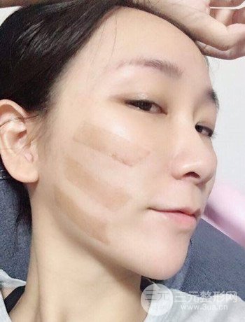 面部埋埋蛋白線.提升改良皮膚松弛，立現(xiàn)小V臉