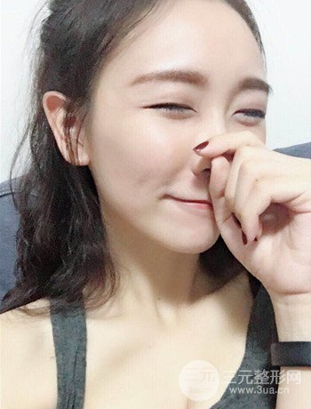 面部埋埋蛋白線.提升改良皮膚松弛，立現(xiàn)小V臉