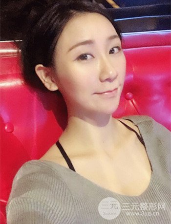 面部埋埋蛋白線.提升改良皮膚松弛，立現(xiàn)小V臉