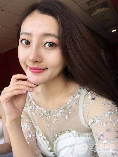 【肋軟骨隆鼻+歪鼻矯正案例】降低風(fēng)險(xiǎn)無排異，可隨意揉捏