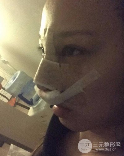 武漢美侖陳遠(yuǎn)海假體隆鼻案例，恢復(fù)過程分享~