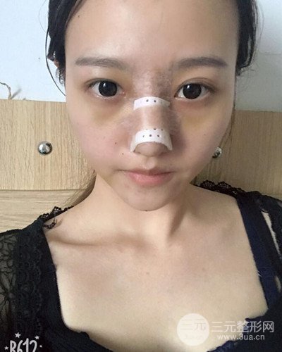 武漢美侖陳遠(yuǎn)海假體隆鼻案例，恢復(fù)過程分享~