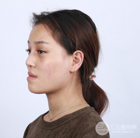 【下頜角+顴骨+下巴】全臉磨骨整形，術(shù)后的我人生開掛了！