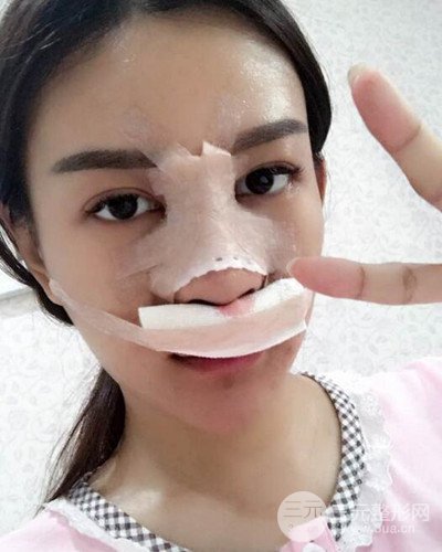 南京華美沈正宇假體隆鼻恢復(fù)過程前后對比圖分享~