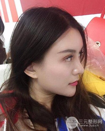 南京華美沈正宇假體隆鼻恢復(fù)過程前后對比圖分享~