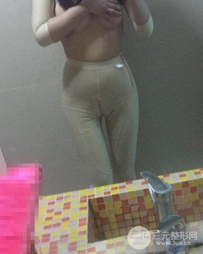廣州韓妃大腿吸脂案例，恢復(fù)過程前后對(duì)比圖片分享~