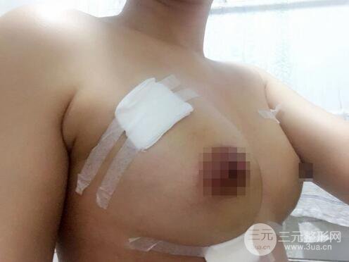 自體脂肪納米豐胸三個(gè)月術(shù)后果展示（附圖）