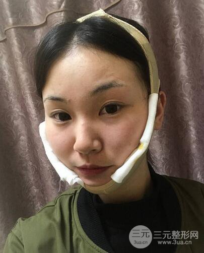下頜角磨骨整形全過(guò)程分享，附上術(shù)后恢復(fù)照片~