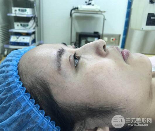 硅膠隆鼻術(shù)前術(shù)后對比照片分享，走上顏值頂峰