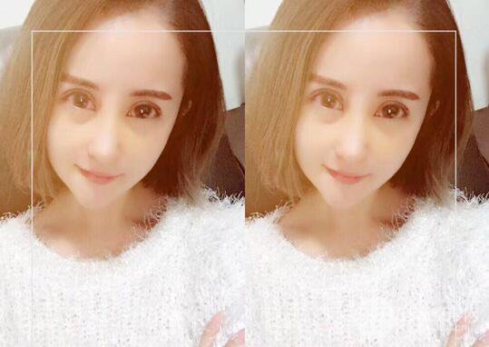 硅膠隆鼻術(shù)前術(shù)后對比照片分享，走上顏值頂峰