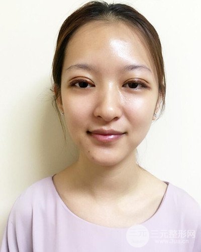 深圳蒳美邇黃海彬雙眼皮案例恢復(fù)過程對比圖分享~
