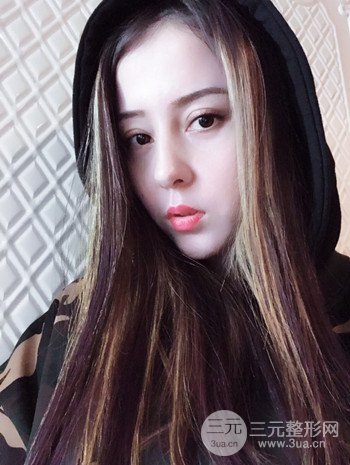 廣州內(nèi)切去眼袋術(shù)后恢復(fù)過程案例對比分享