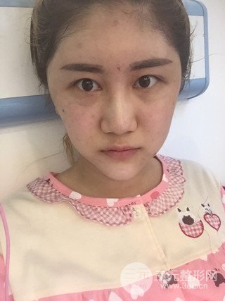 深圳臻希美詳細(xì)部自體脂肪填充果對(duì)比超明X