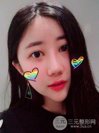 深圳臻希美詳細(xì)部自體脂肪填充果對(duì)比超明X