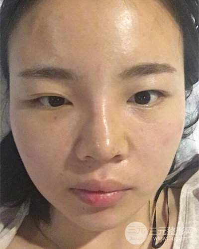 蘇州美萊尹飛隆鼻整形案例，前后恢復(fù)圖分享~