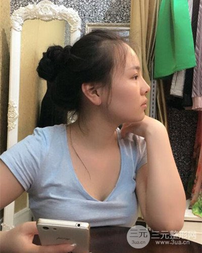 蘇州美萊尹飛隆鼻整形案例，前后恢復(fù)圖分享~