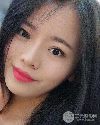 蘇州美萊尹飛隆鼻整形案例，前后恢復(fù)圖分享~