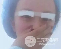 南京鼓樓譚謙醫(yī)生切開雙眼皮案例，恢復(fù)圖分享~