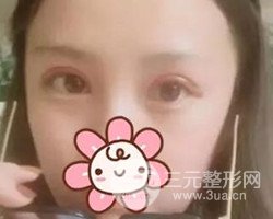 南京鼓樓譚謙醫(yī)生切開雙眼皮案例，恢復(fù)圖分享~