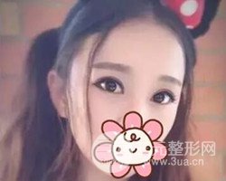 南京鼓樓譚謙醫(yī)生切開雙眼皮案例，恢復(fù)圖分享~