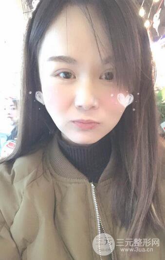 磨骨瘦臉（下頜角切除）恢復過程及前后對比照片