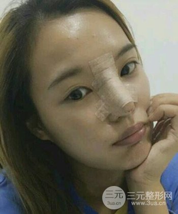 模特做隆鼻整形真實日記分享，附上恢復過程圖