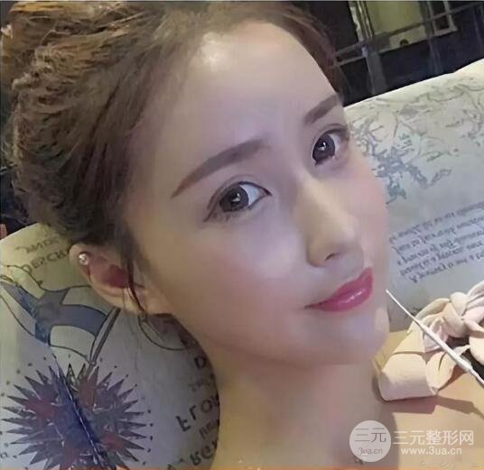 王明利自體脂肪填充案例恢復(fù)過程分享