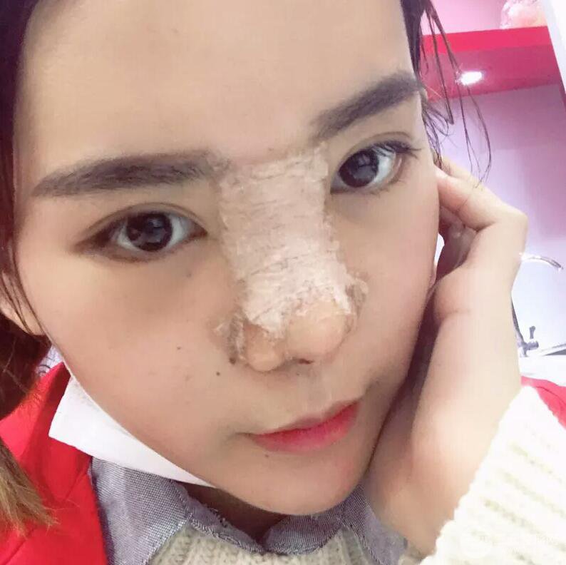 硅膠隆鼻+自體耳軟骨墊鼻尖案例前后對比照片分享