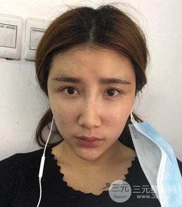 網(wǎng)絡(luò)主播做自體脂肪豐太陽穴真實案例分享，果杠杠的