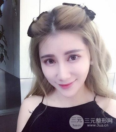 網(wǎng)絡(luò)主播做自體脂肪豐太陽穴真實案例分享，果杠杠的