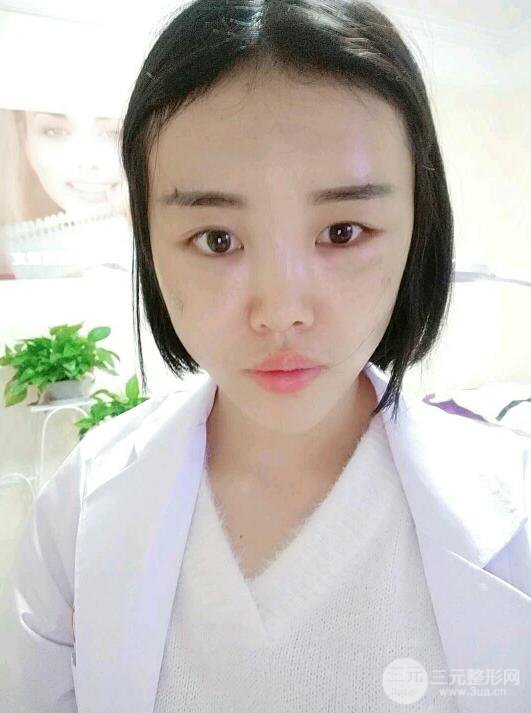 成都軍大鐘正強(qiáng)自體脂肪填充面部案例恢復(fù)圖，馬上變成“初戀臉”